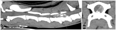 Case report: Clinical and pathological findings in a canine patient with intervertebral disk extrusion resembling progressive myelomalacia